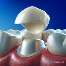 Zirconia Crowns & Bridges